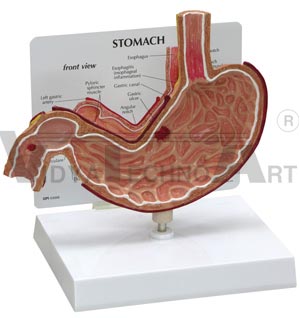 Stomach With Ulcer